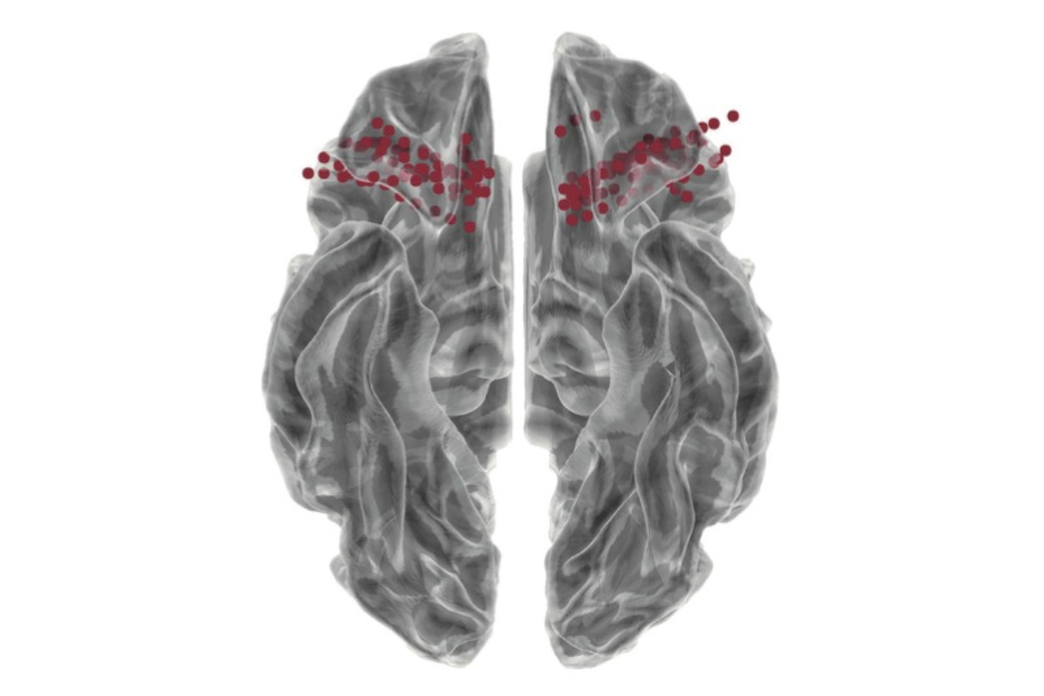 The research team utilized stereotactic electroencephalogram recordings of intracranial brain signals in treating epilepsy patients. The illustration depicts the electrode locations within the orbitofrontal cortex 166, correlated with preference responses.