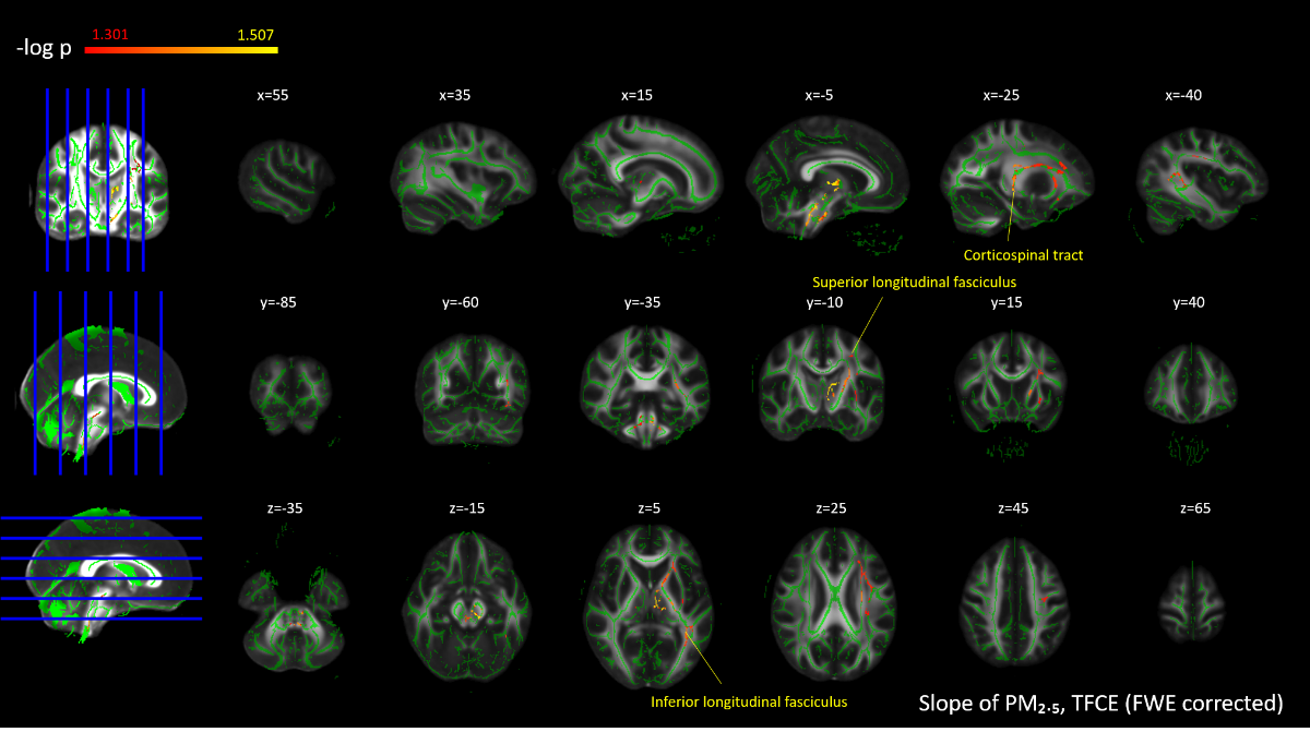 The greater the reduction in PM2.5 levels, the more significant the correlation with brain regions. The red and yellow areas indicate statistically significant regions.