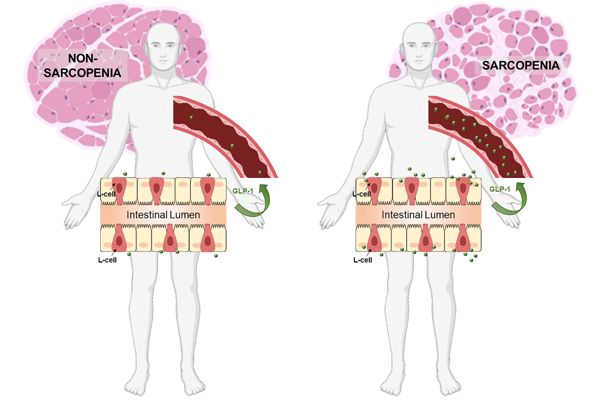 sarcopenia glp 1 Causes of and frailty in people taking GLP1RAs Glucagonlike peptide1 receptor agonists and