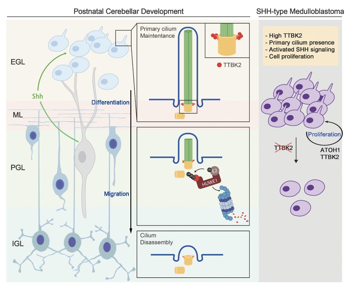 The research team discovered that SHH signaling protects a protein called TTBK2, allowing it to remain on the cell’s primary cilium and promote neuronal growth. However, in brain tumors, this mechanism is hijacked to accelerate tumor progression. The study suggests that inhibiting TTBK2 could lead to new therapeutic strategies for SHH-subtype medulloblastoma.
