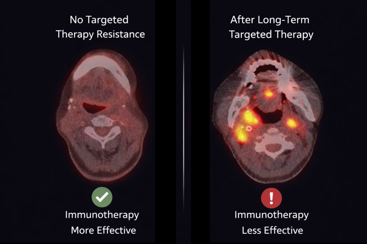 The findings show that prolonged targeted therapy in patients with head and neck cancer can heighten tumor alertness, reducing the effectiveness of subsequent immunotherapy. (Image: positron emission tomography scan of a patient with head and neck cancer.)