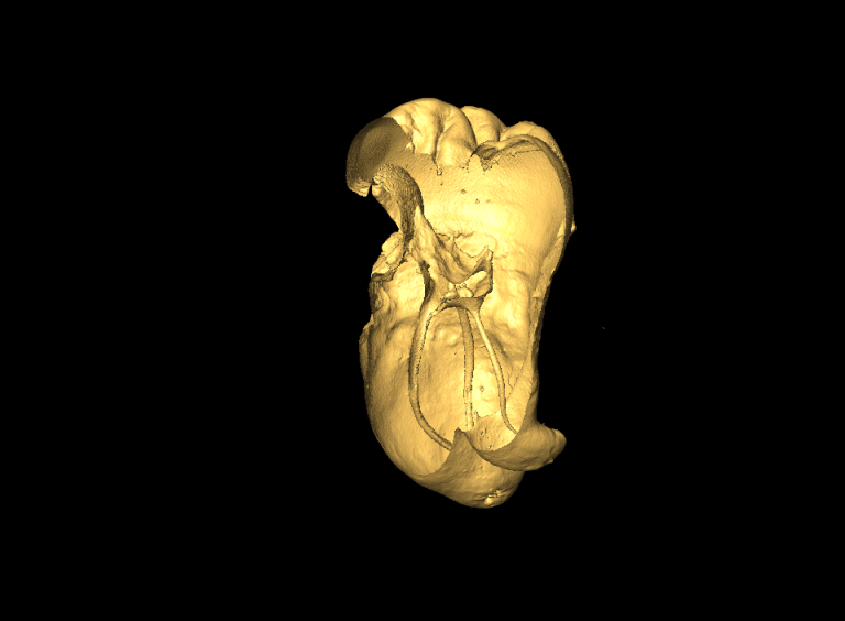 3D surface image simulation of teeth